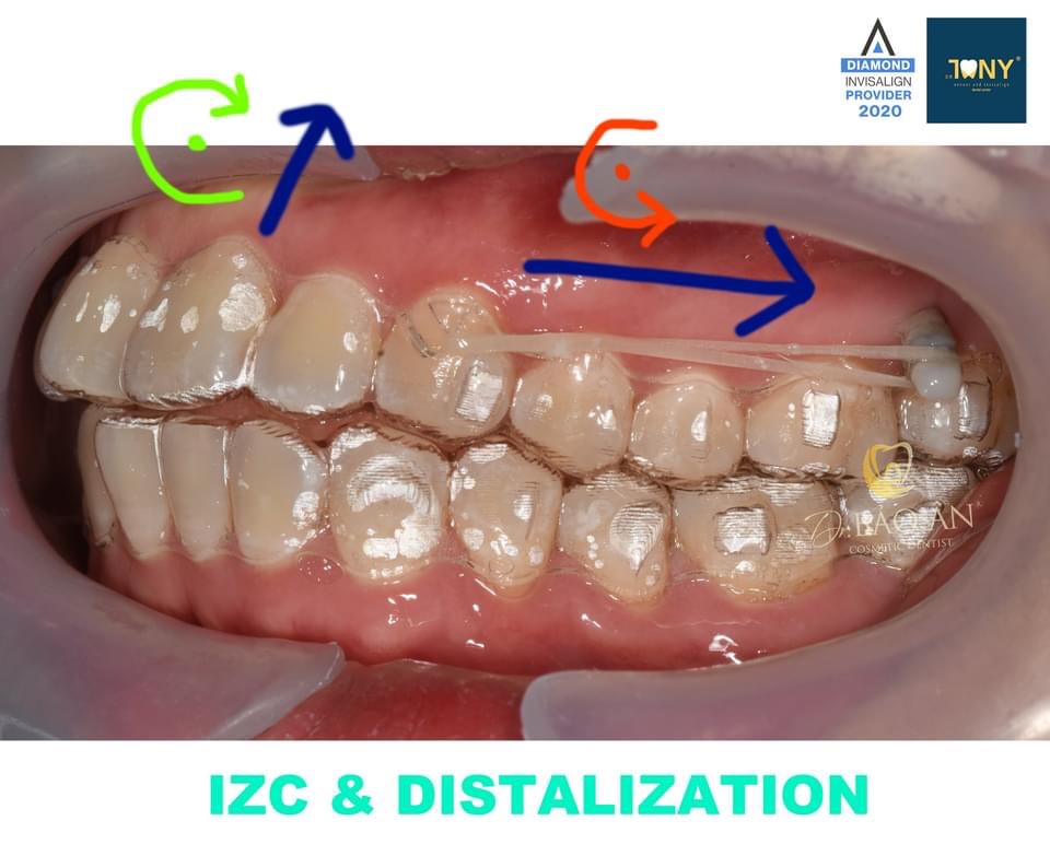 Một Ca Sai Khớp Cắn Hạng 2