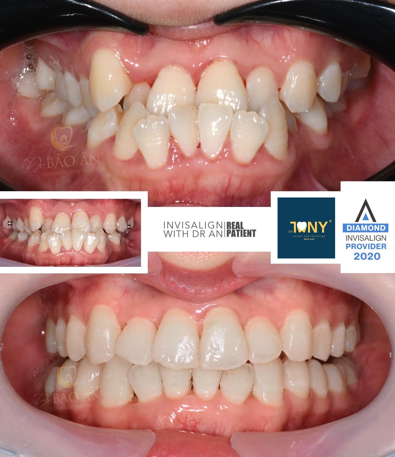 Tiến Trình Ca Invisalign