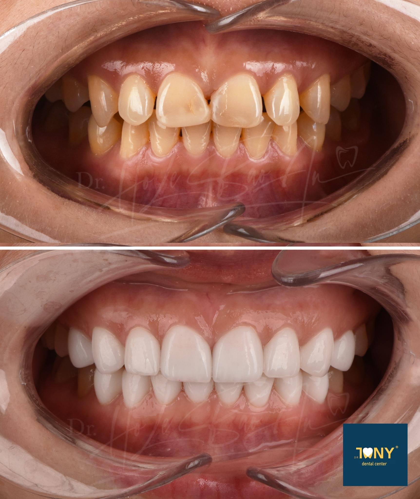 Cấu trúc hàm răng có cấu tạo như thế nào  Sức khỏe răng miệng