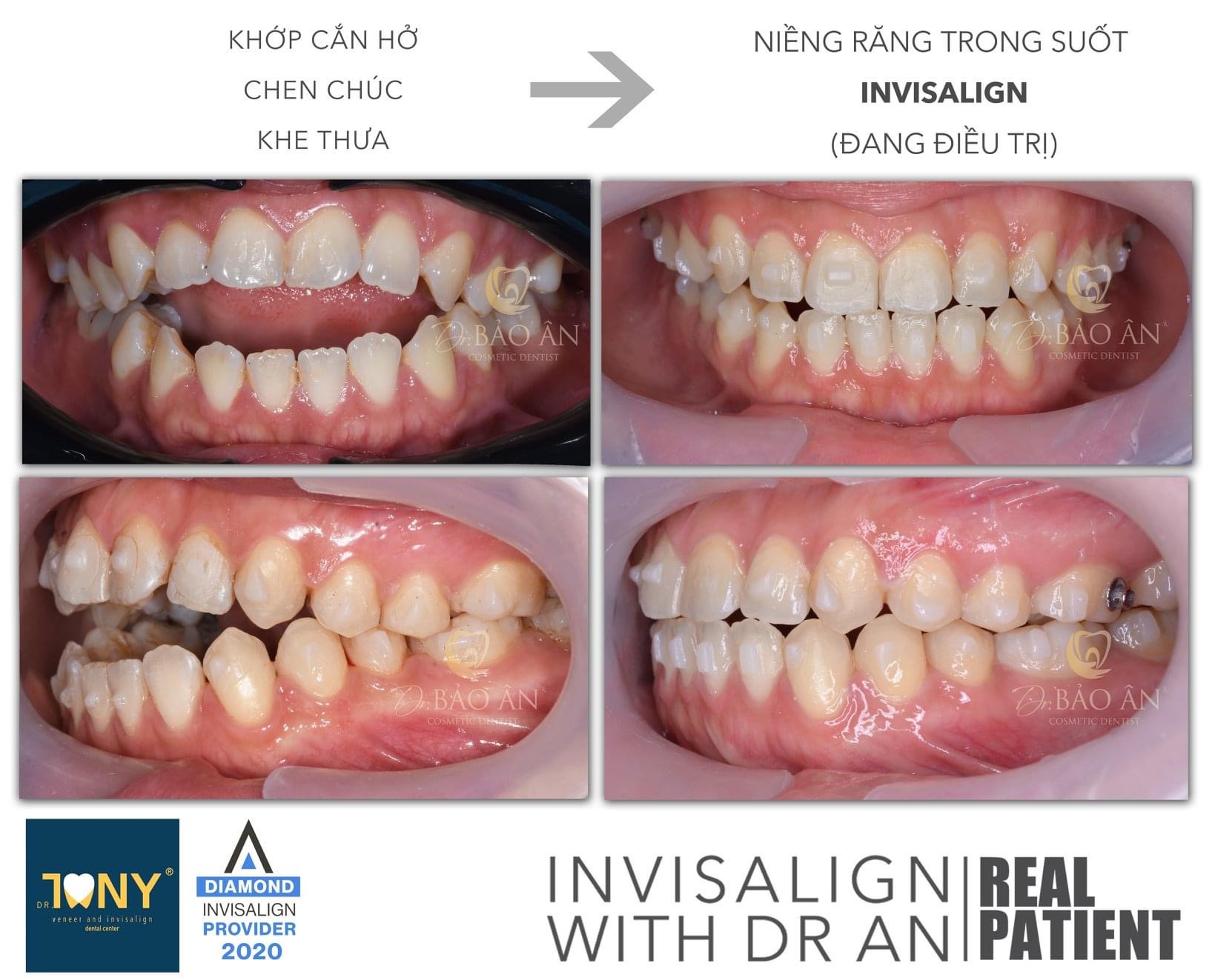 TIẾN TRÌNH CA INVISALIGN  (ĐANG ĐIỀU TRỊ)