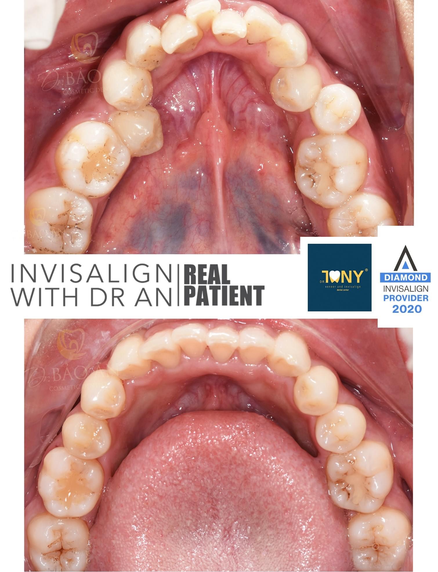 Tiến Trình Ca Invisalign ( Tinh Chỉnh )