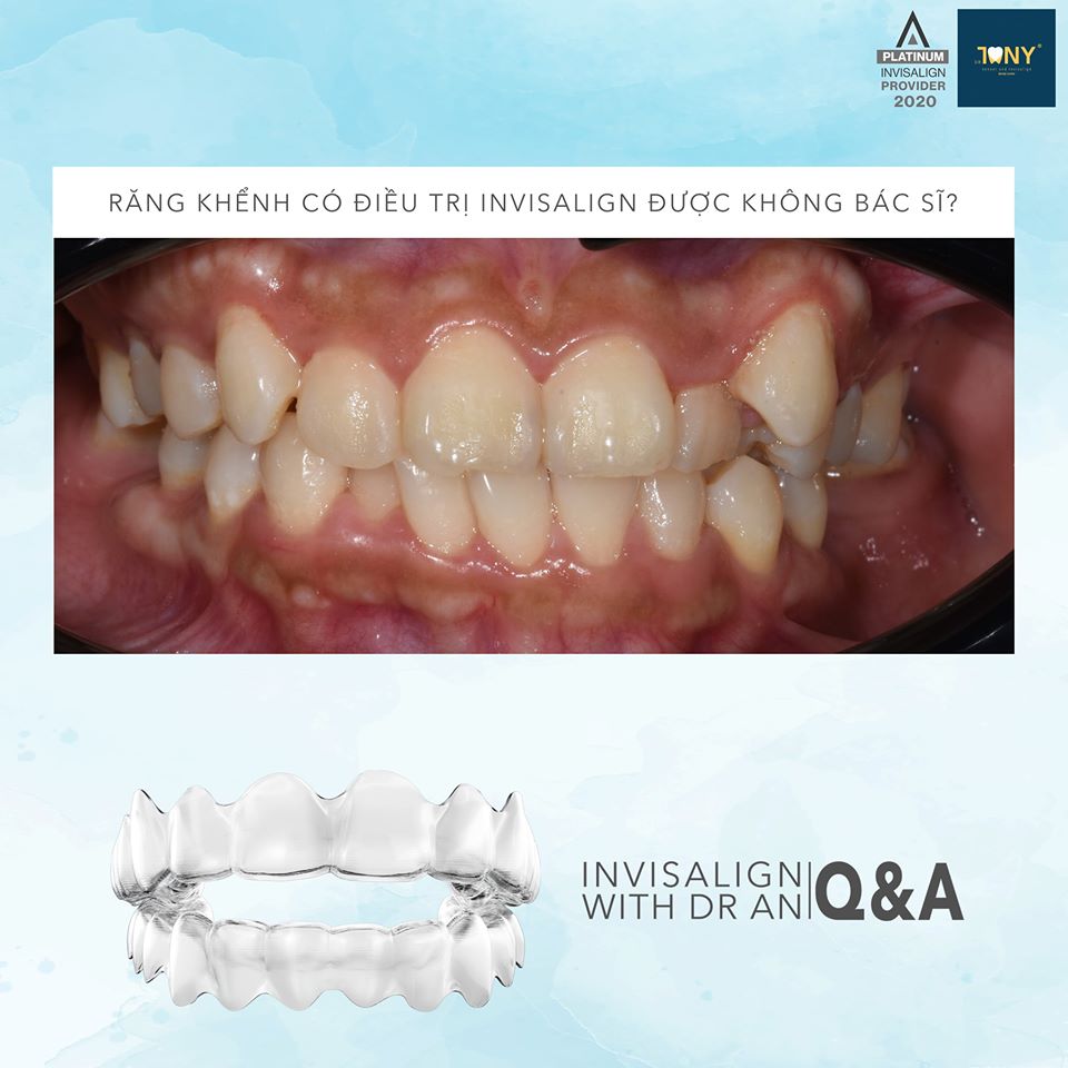 Răng khểnh có điều trị Invisalign được không ?