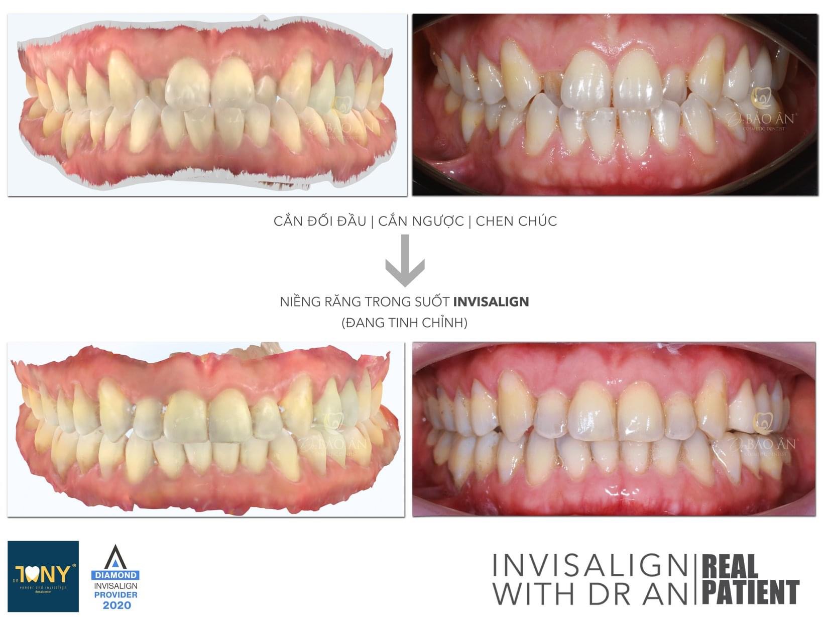 Tiến Trình Ca Invisalign