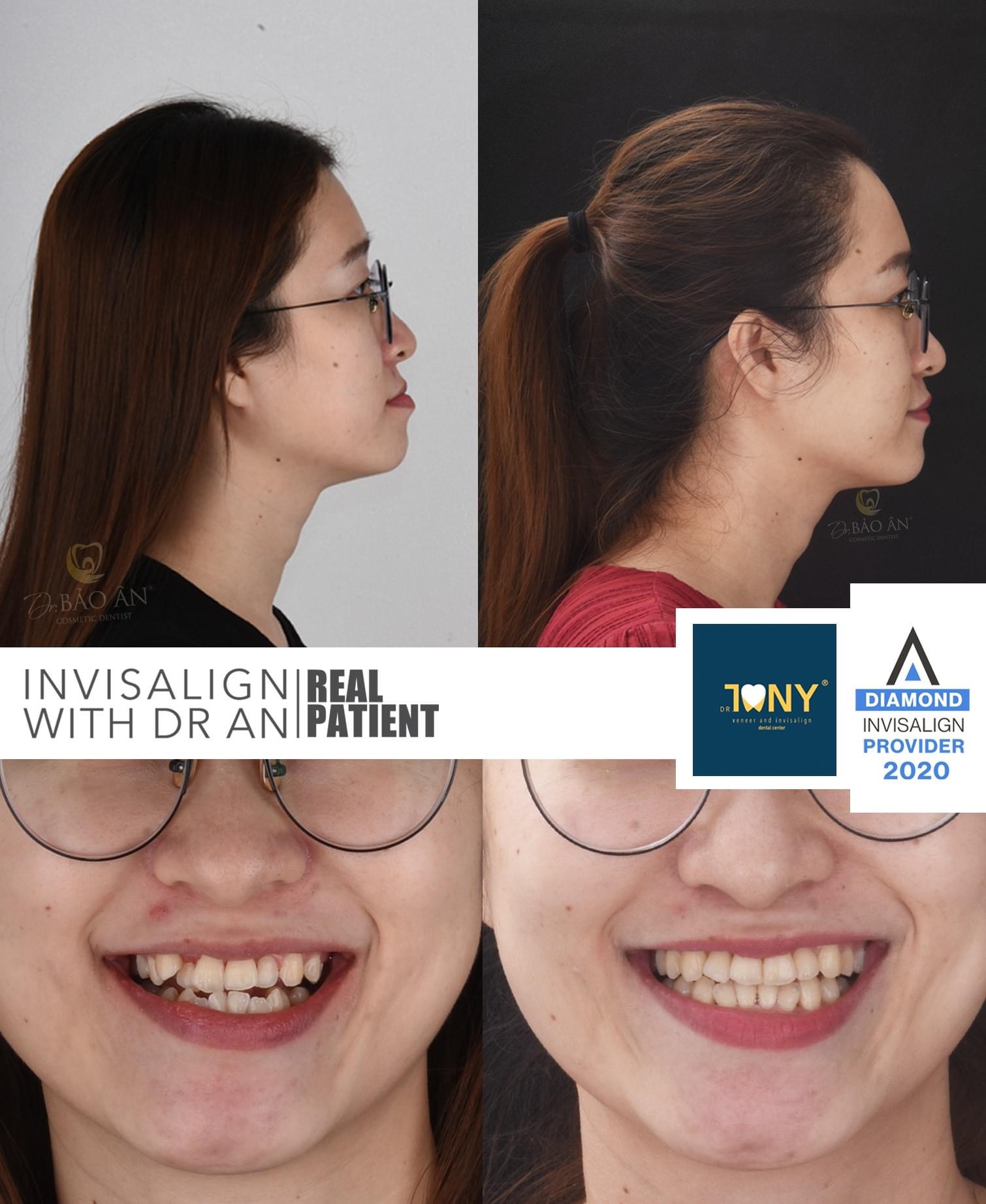 Ca Cải Thiện Móm Vượt Trội