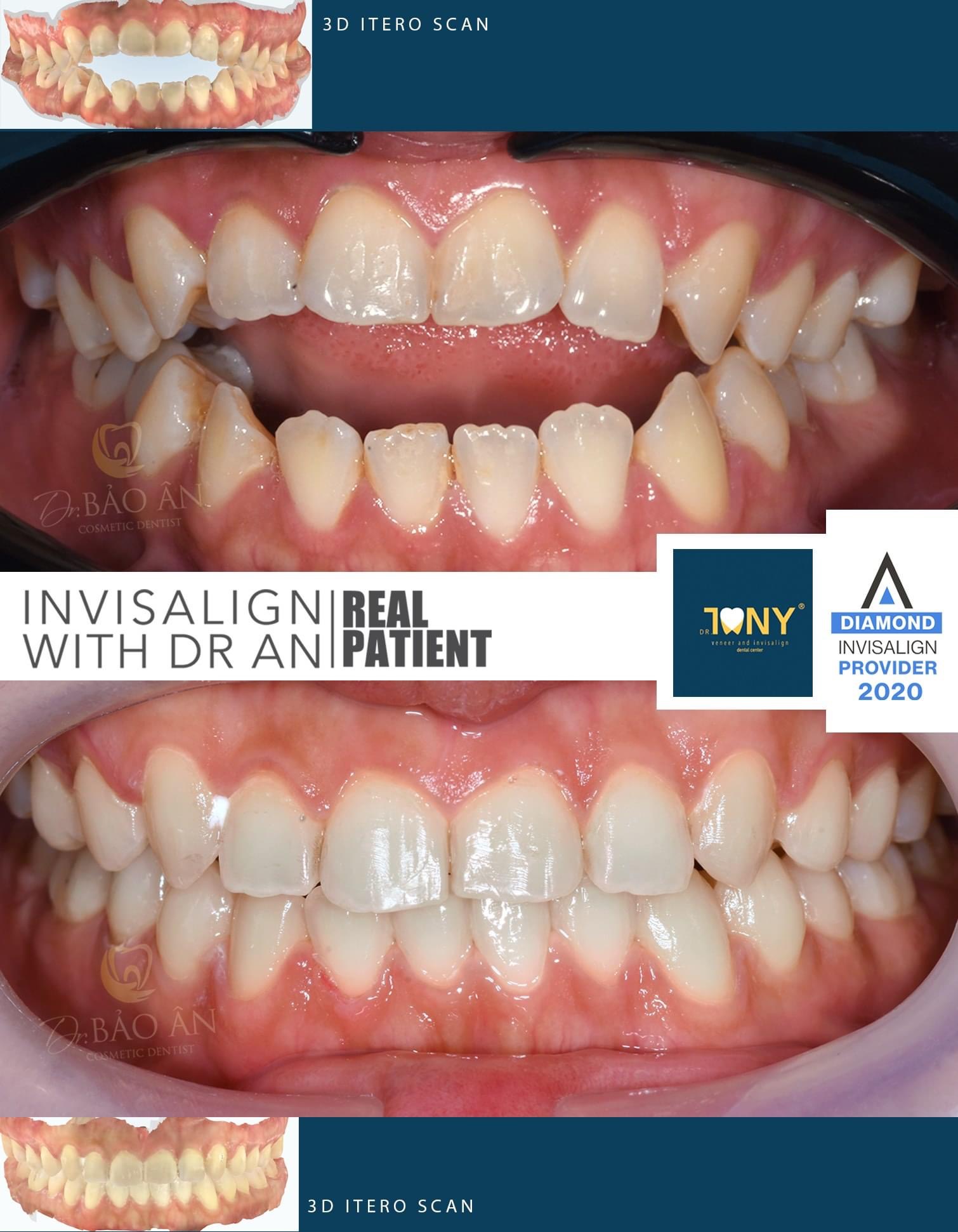 Tiến Trình Ca Invisalign ( Tinh Chỉnh )