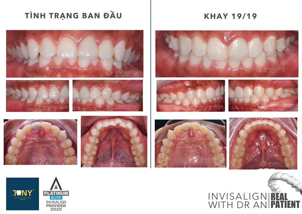 Tiến Trình Niềng Răng Invisalign Với Bs Ân