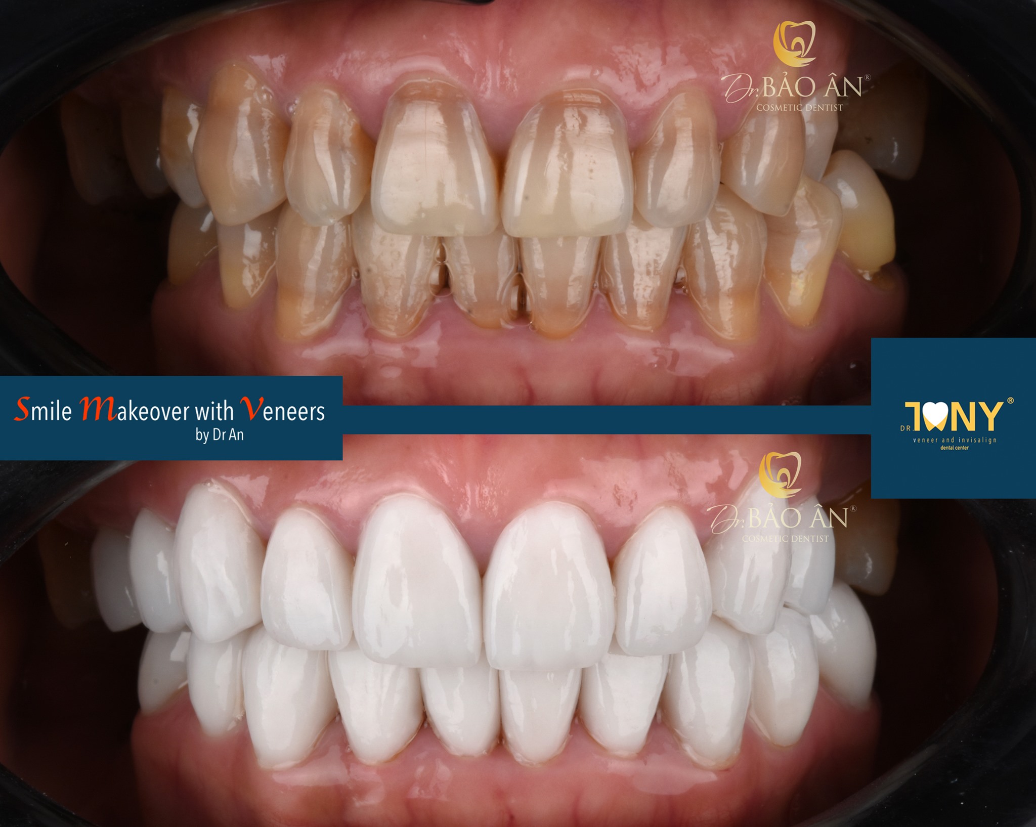 Răng Nhiễm Tetracycline Nặng Có Khuyết Mô Răng ,Chen Chúc Nhẹ,Cắn Ngược Răng Cối Nhỏ