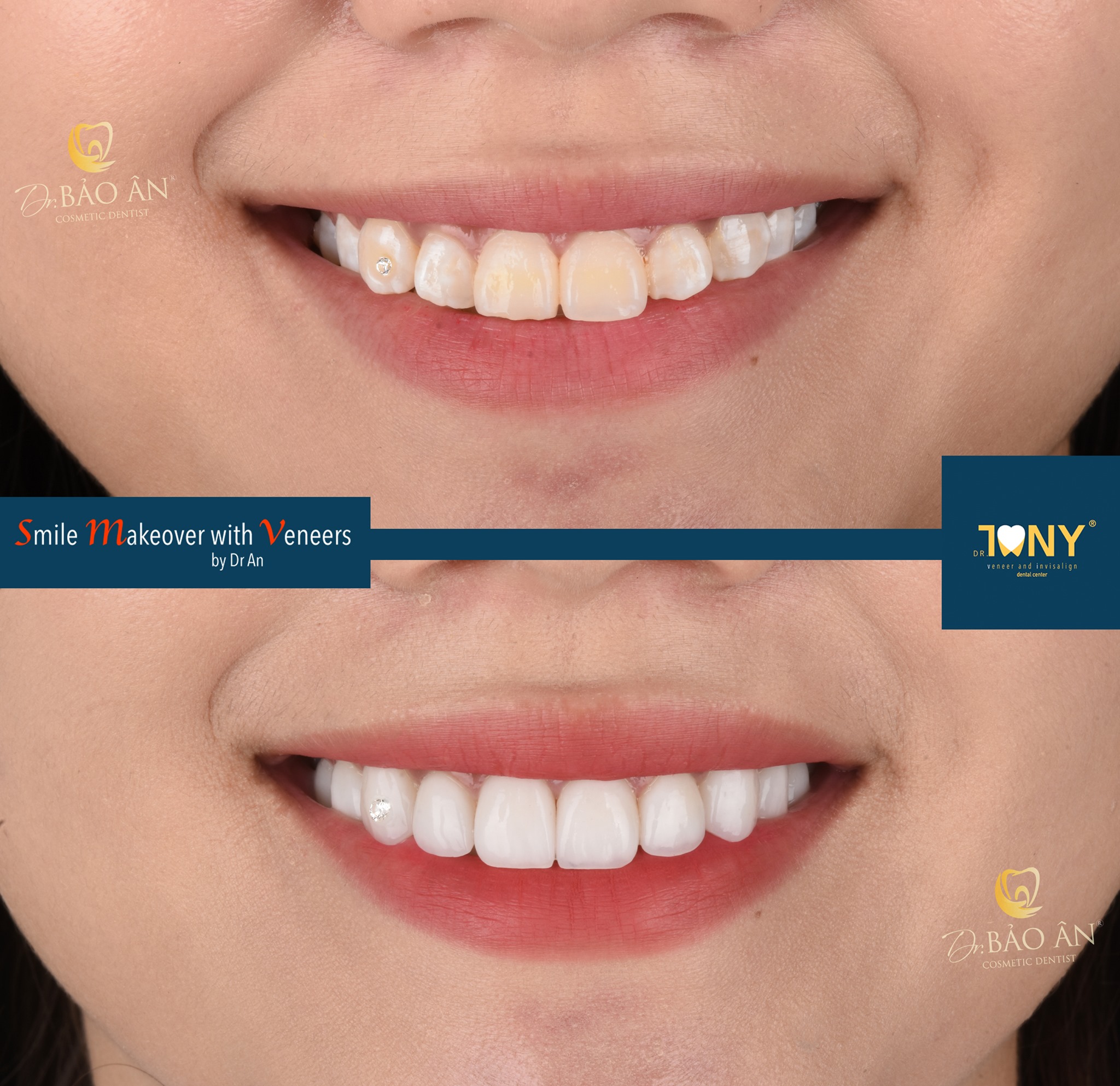 Ca Mặt Dán Sứ Veneer Thẫm Mỹ Yêu Cầu Đính Đá Qúy
