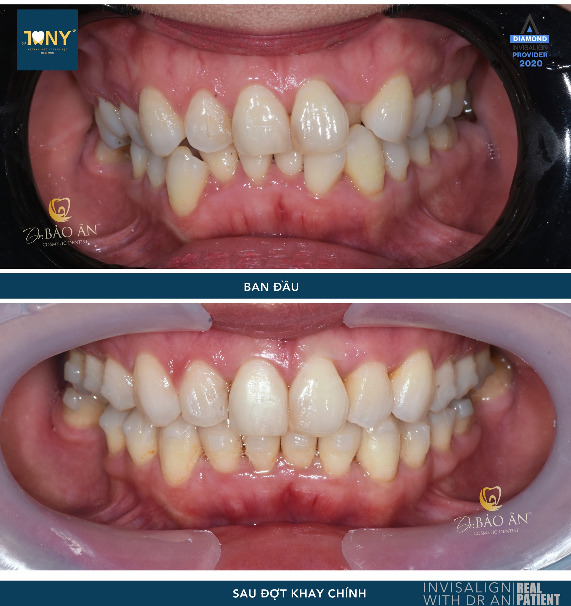 Tiến Trình Ca Invisalign