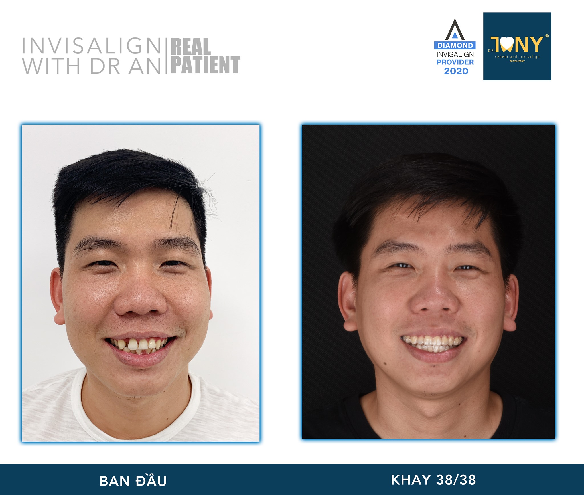 Tiến Trình Ca Invisalign (Khay 38/38)