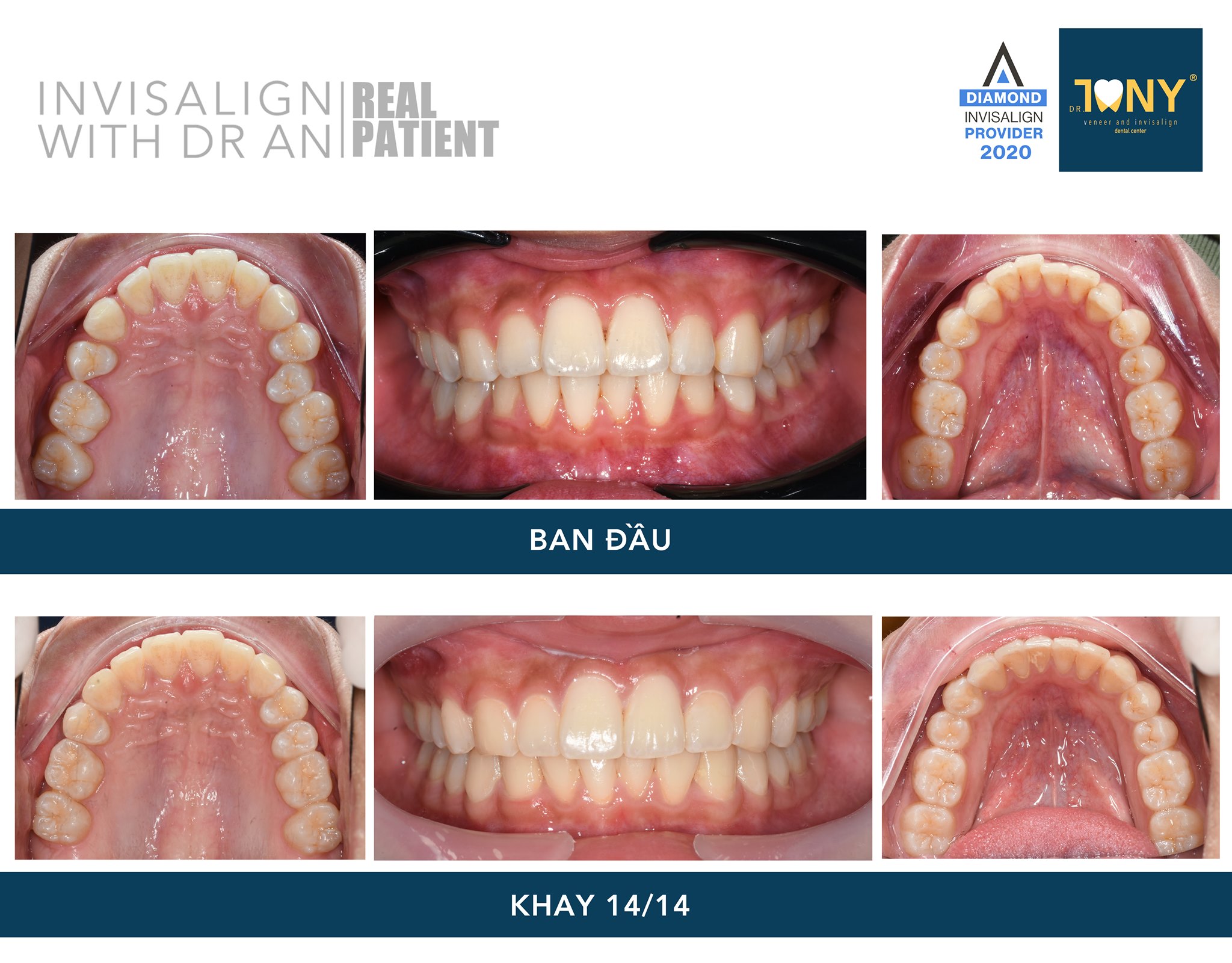 Tiến Trình Ca Invisalign (Khay 14/14)