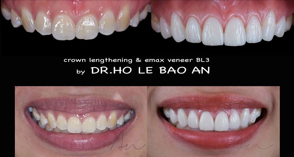 Tình trạng cười hở nướu