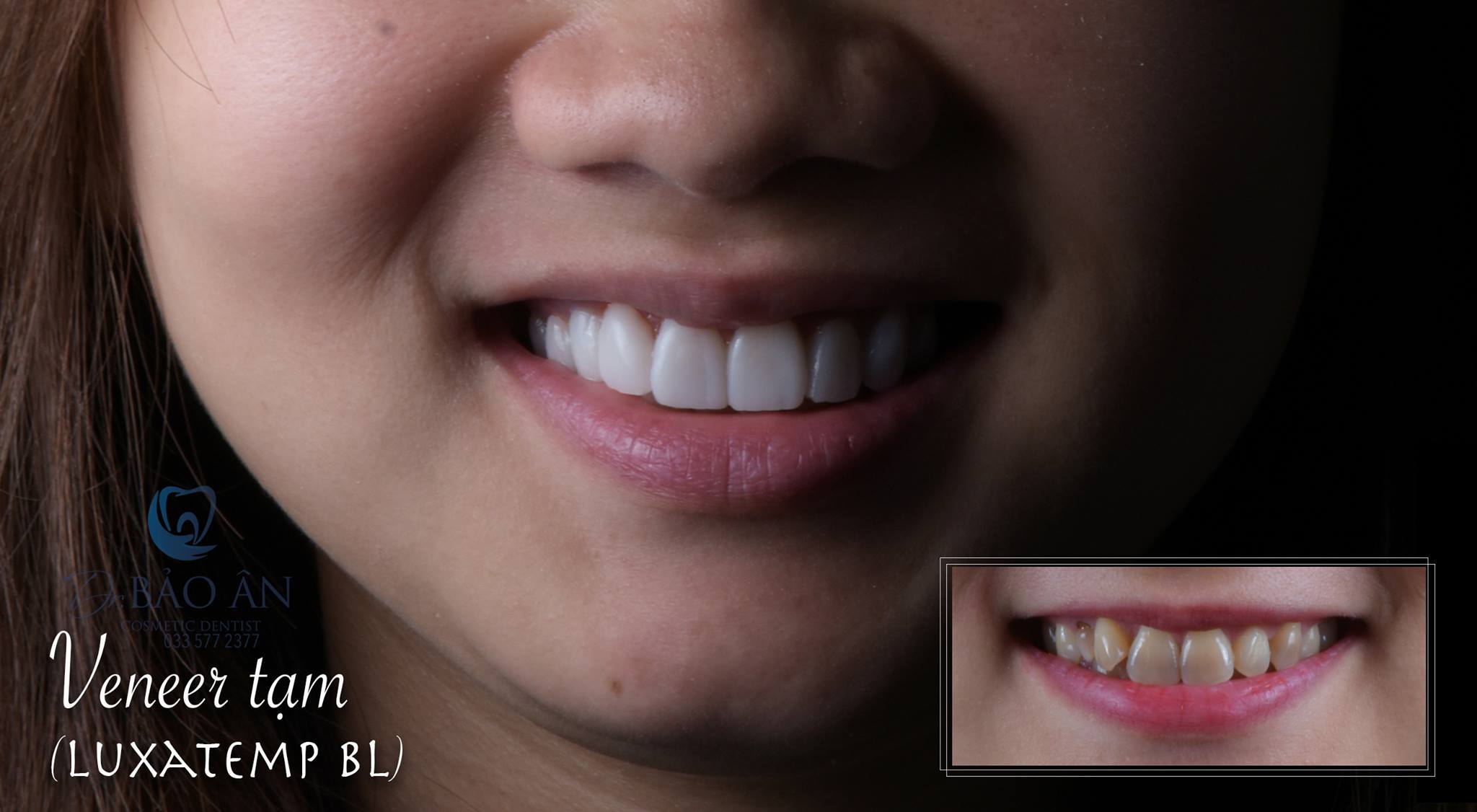 Ca nhiễm Tetracycine