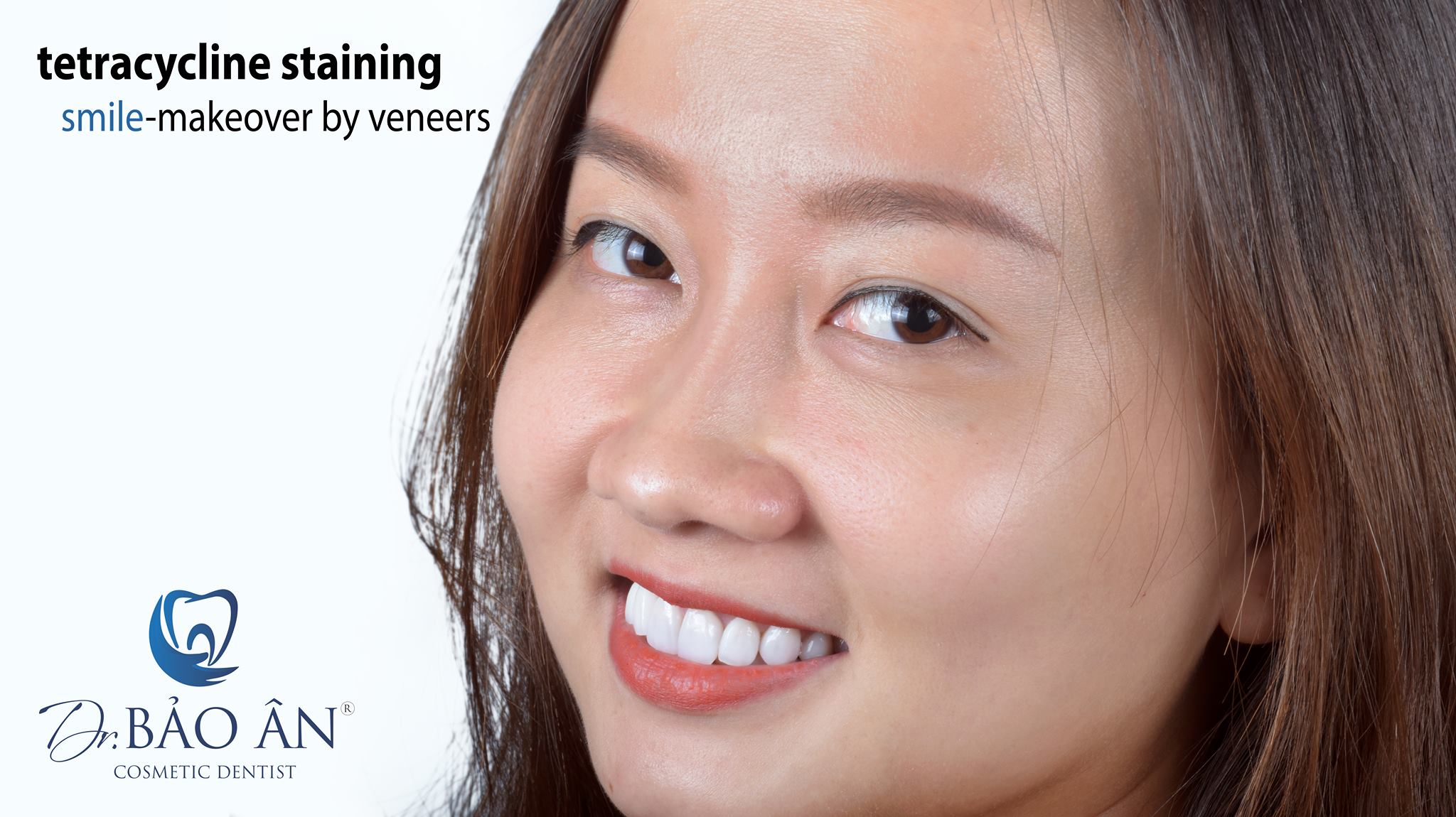 Ca điều trị nhiễm Tetracycline nặng sau tái khám