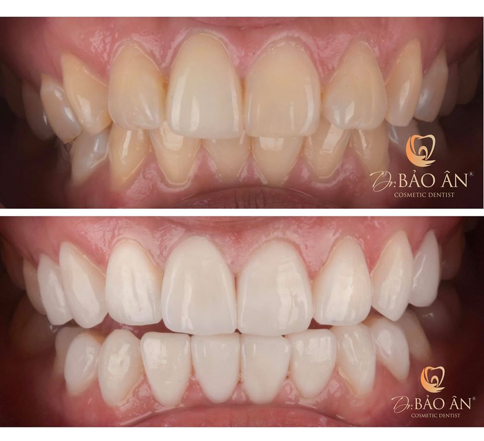 Cải thiện màu sắc răng trắng sáng