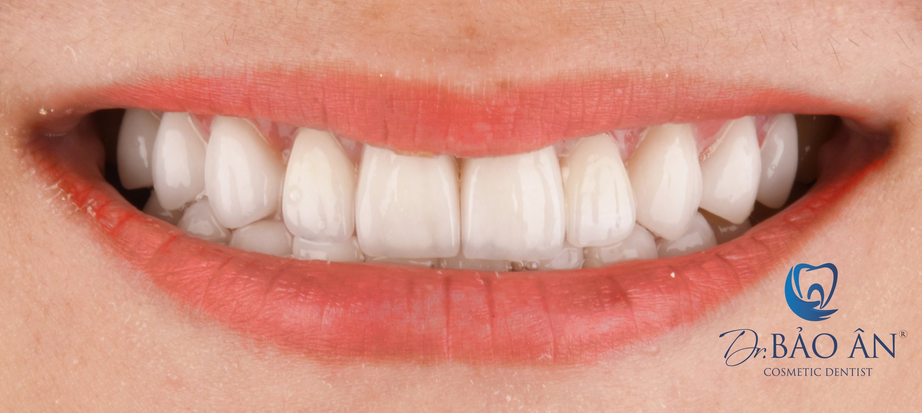 Phục hình thẩm mỹ nụ cười