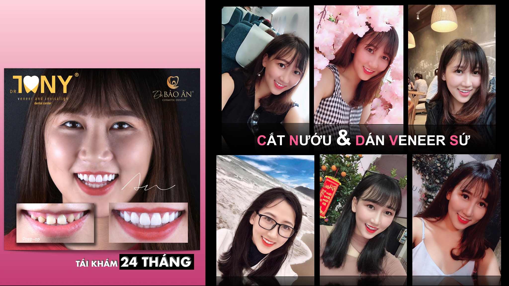Ca làm dài chân răng và veneer