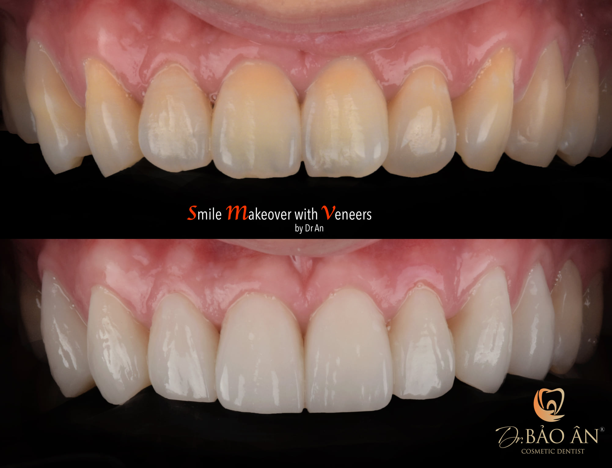 Ca chen chúc răng nhẹ