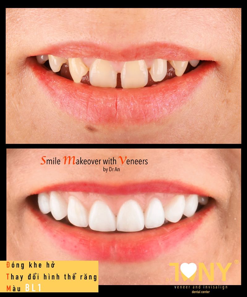 Ca nụ cười hẹp