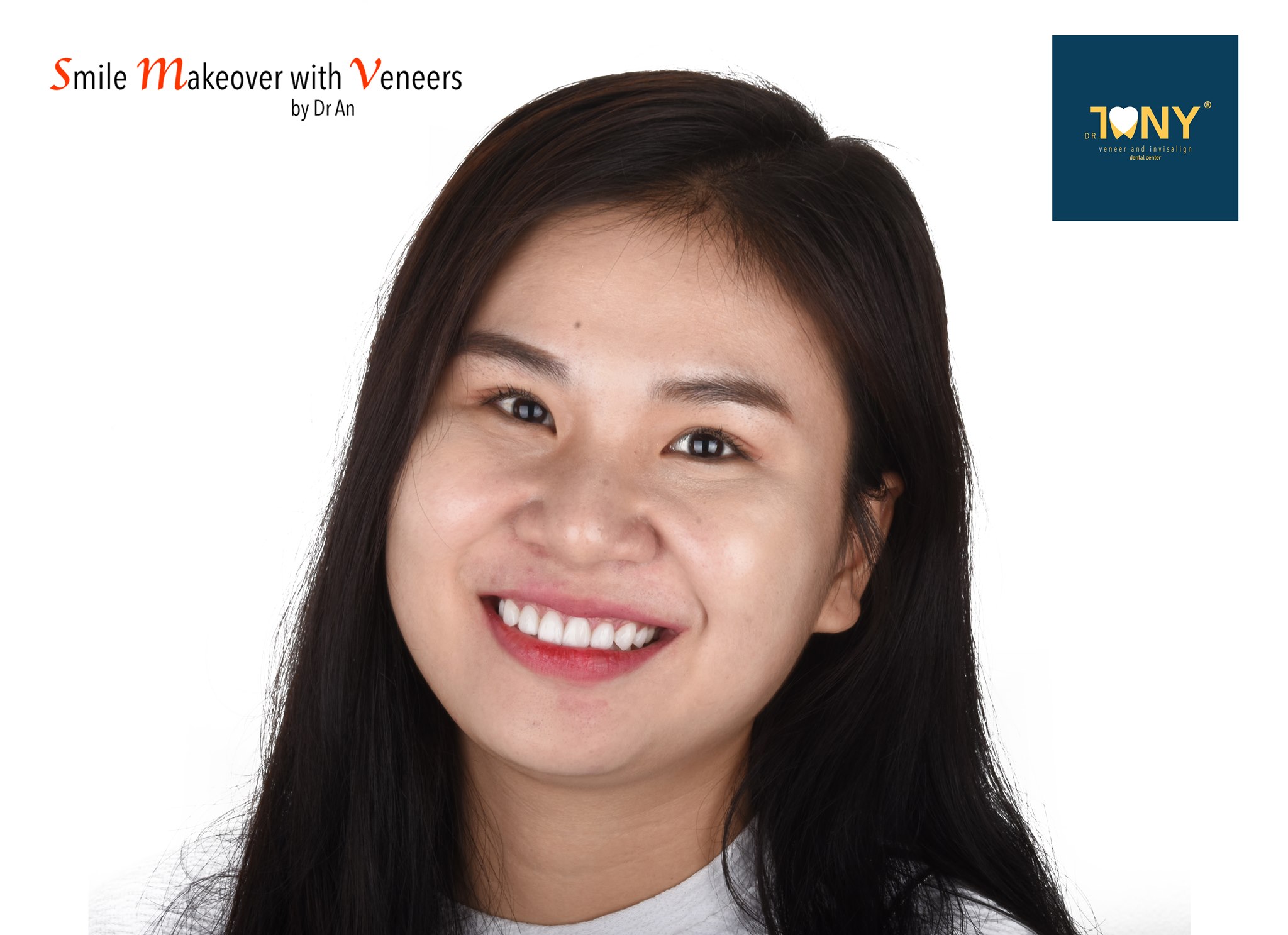 Ca phục hồi răng cửa trên mòn và vỡ