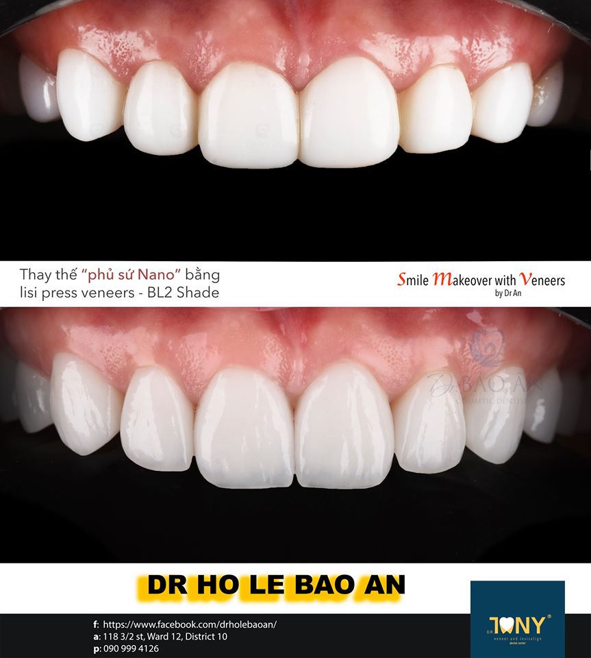 Thay thế Composite cũ bằng Veneer