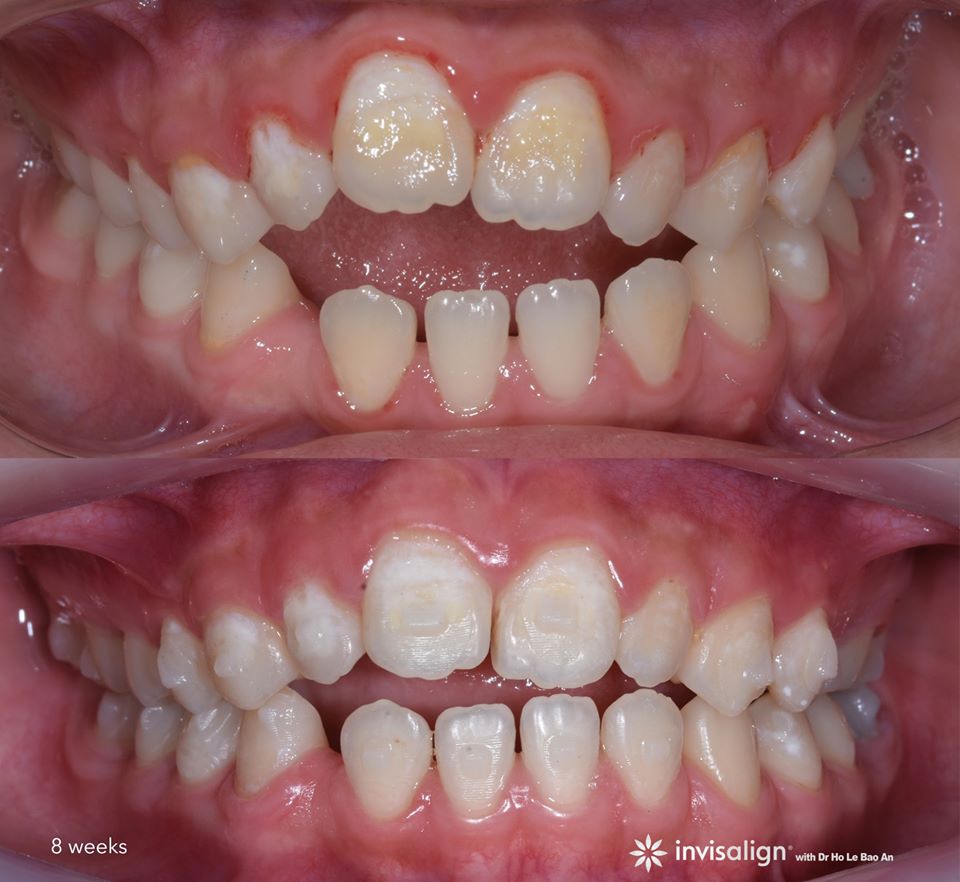 Ca cắn hở tái khám sau 8 tuần đeo khay