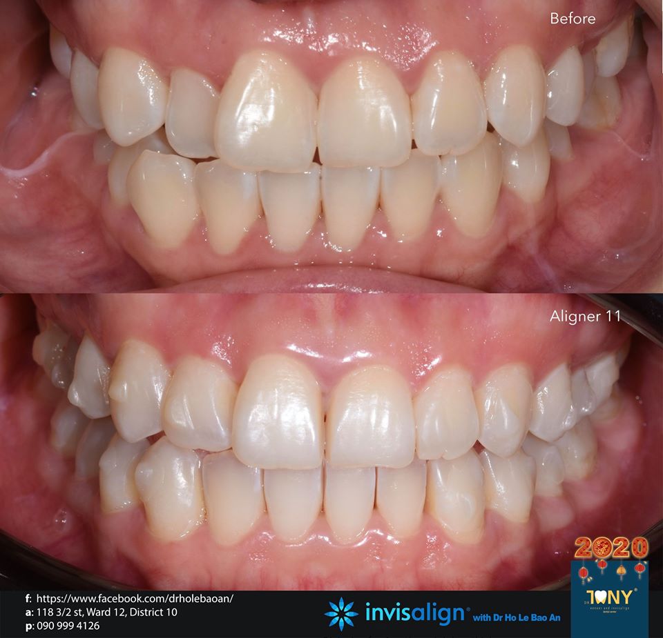 Ca Invisalign trong giai đoạn điều trị