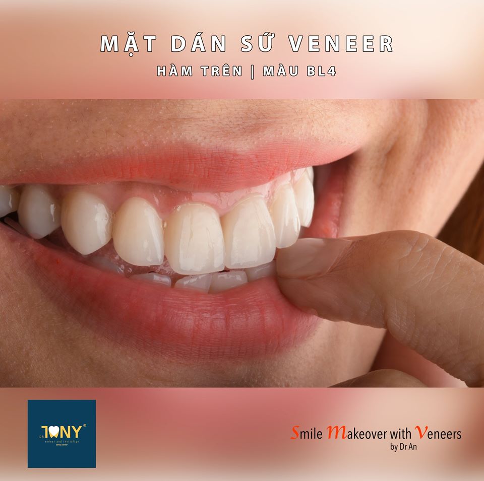 Mặt Dán Sứ Veneer Màu BL4 Cho Bạn Một Nụ Cười Hoàn Hảo Và Thật Tự Nhiên !