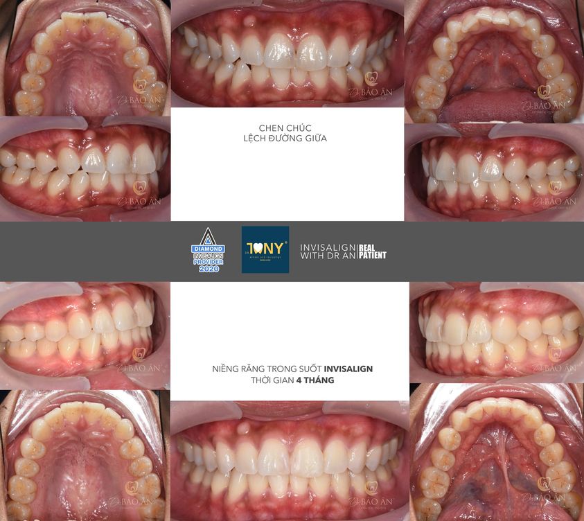 Tiến Trình Niềng Răng Invisalign Với Bs Ân