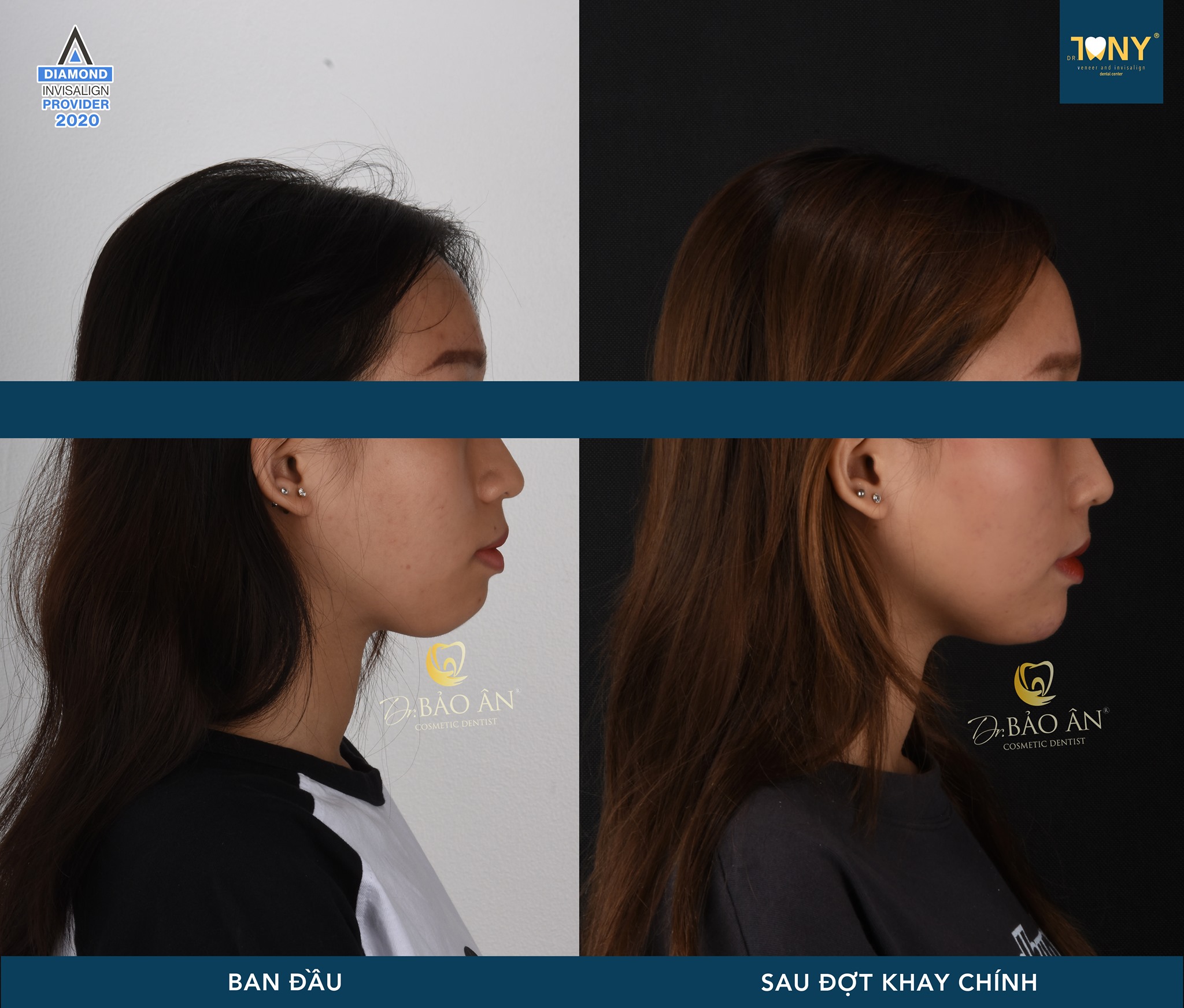 Tiến Trình Ca Invisalign (Giai Đoạn Kết Thúc)