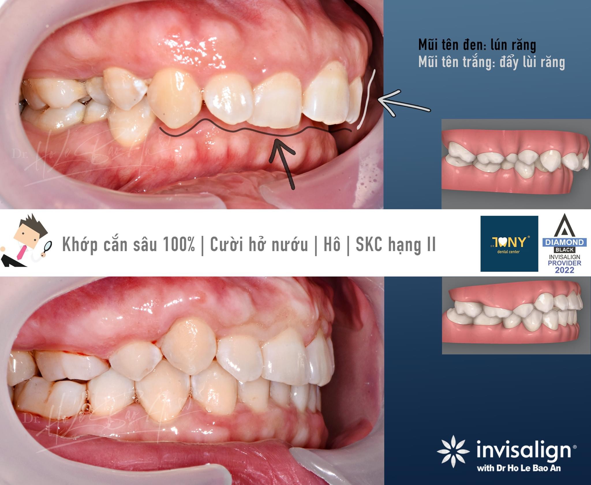 Giải Khớp Cắn Sâu Bằng Điều Trị Khay Invisalign