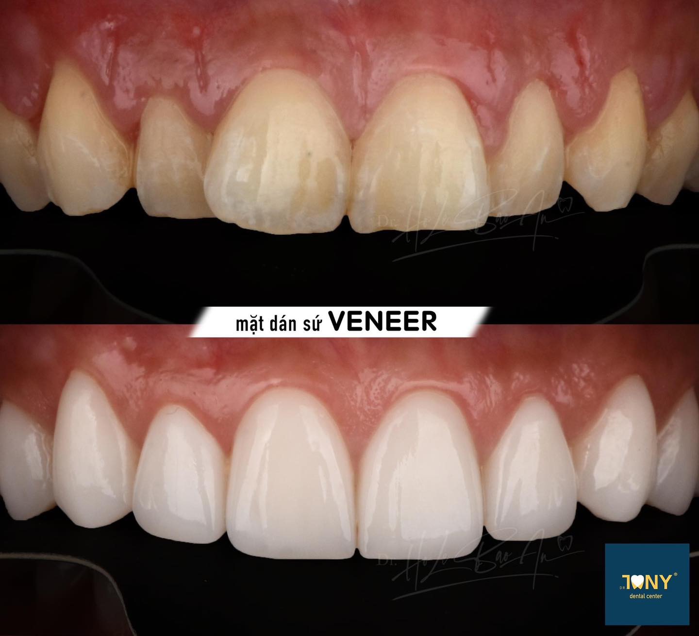 Mặt Dán Sứ Thẩm Mỹ