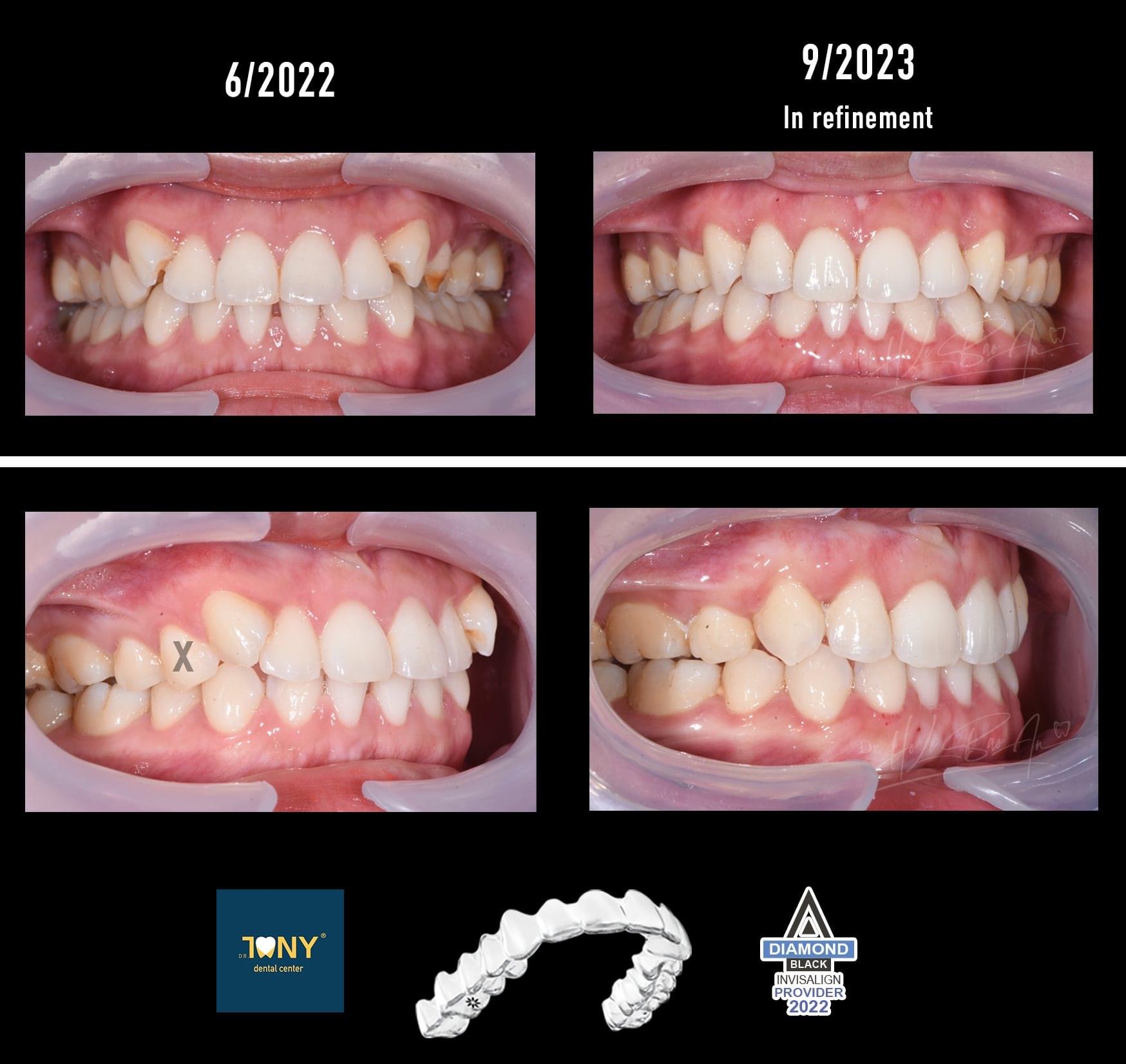 Ca Niềng Invisalign