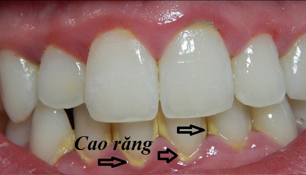 Khi nào nên lấy cao răng ?